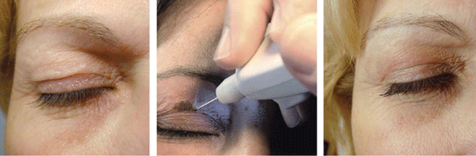 SkinMedix Plexr behandeling bovenoogleden