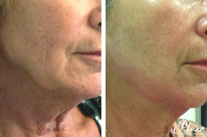 SkinMedix Plexr behandeling kaaklijn rimpels