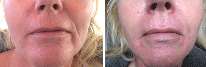 SkinMedix Plexr behandeling lippen neus plooi rimpels