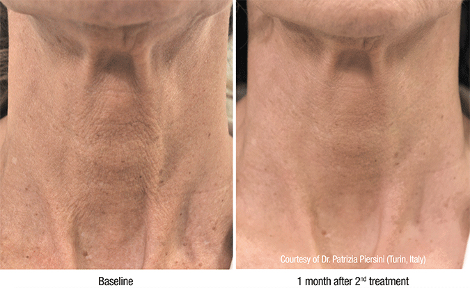 SkinMedix Filler Behandeling Profhilo Filler