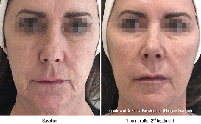 SkinMedix Filler Behandeling Profhilo Filler