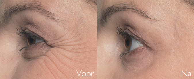 botox behandeling kraaienpootjes SkinMedix