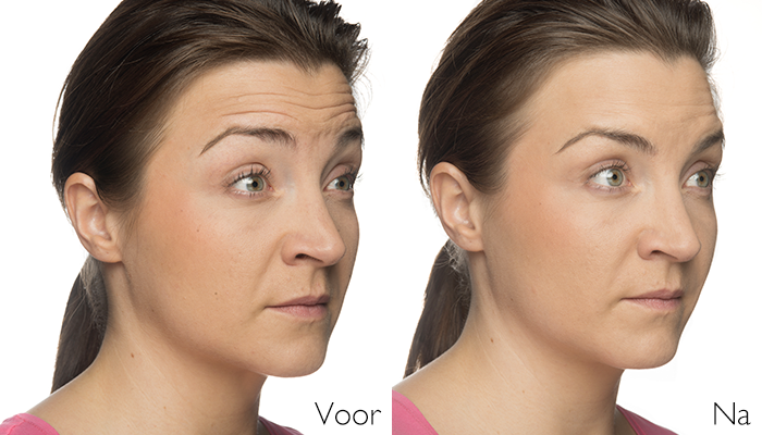 botox behandeling voorhoofdrimpels Skinmedix