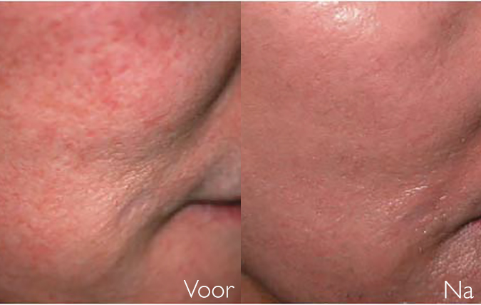 Voor en na behandeling rosacea couperose op wang SkinMedix