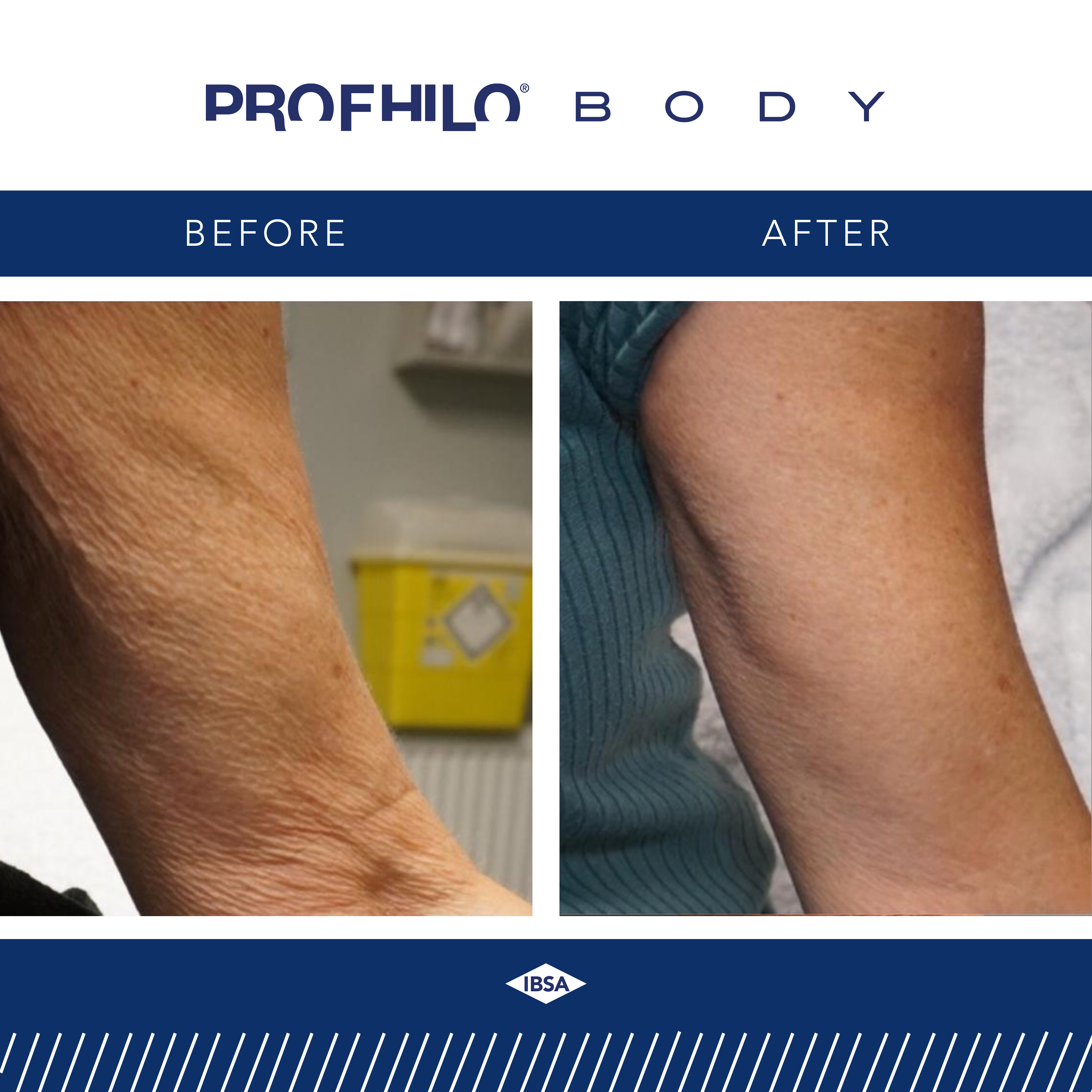Profhilo Body